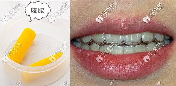 在<!--<i data=20240703-sp></i>-->戴透明牙套矯正牙齒的體驗
