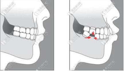 缺牙不及時(shí)種牙的危害