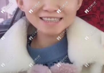 20歲滿(mǎn)口活動(dòng)假牙照片