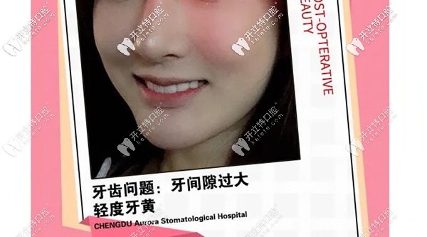 在成都做完瓷貼面后的樣子