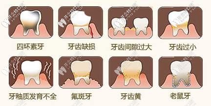 牙齒貼面適合人群