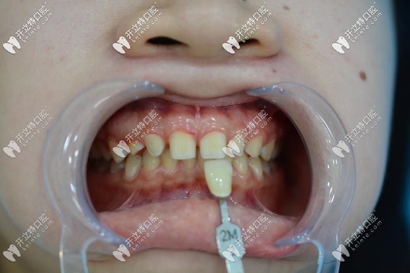 牙齒貼面比色，<!--<i data=20240703-sp></i>-->口腔