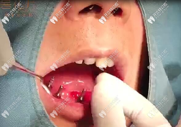 <!--<i data=20240703-sp></i>-->口腔半口即刻負(fù)重種植牙<span style=