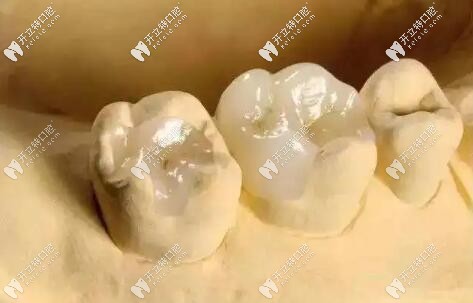 嵌體補(bǔ)牙