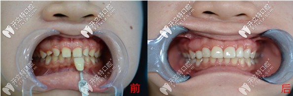 武漢仁愛口腔武漢小姐姐分享超薄美加瓷貼面修復門牙縫隙的效果及價格