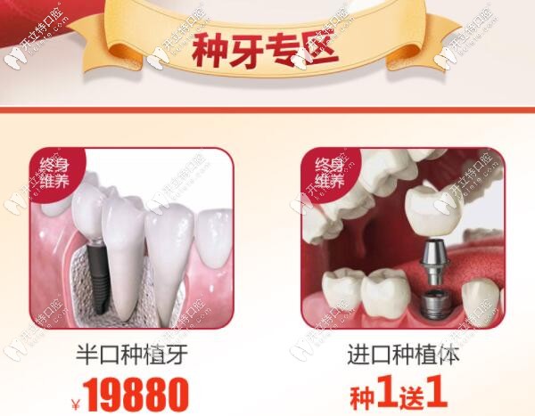 南寧柏樂口腔種植牙優(yōu)惠價格