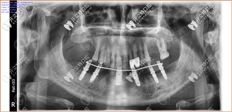 <!--<i data=20240703-sp></i>-->口腔all-on-6半口種植牙真人<span style=