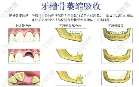能否做種植牙的基礎(chǔ)條件