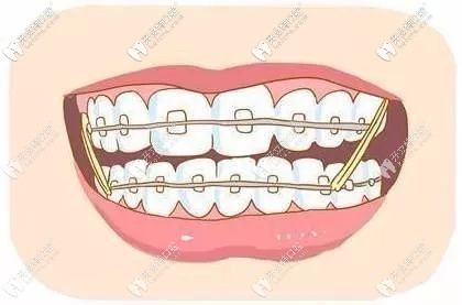 正確的矯正方式
