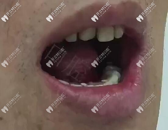 <!--<i data=20240703-sp></i>-->口腔半口all-on-6登騰即刻負(fù)重種植牙<span style=