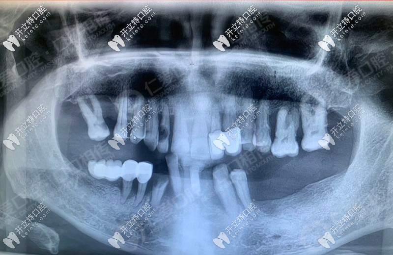 3d導(dǎo)板+all-on-6半口即刻負(fù)重,讓武漢老人當(dāng)天種植牙當(dāng)天用