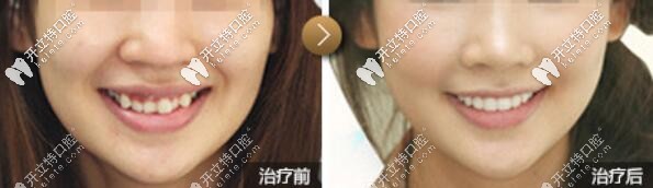 <!--<i data=20240703-sp></i>-->口腔虎牙矯正案例 <!--<i data=20240703-sp></i>-->口腔虎牙矯正案例