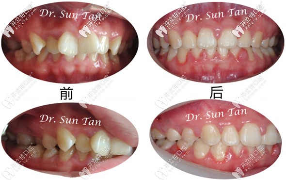 據(jù)說insignia正畸價格和隱適美差不多？