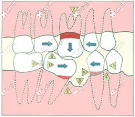 牙齒缺失的危害