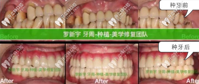 無錫美奧口腔重度牙周炎患者種牙前后對比照片 無錫美奧口腔重度牙周炎患者種牙前后對比照片