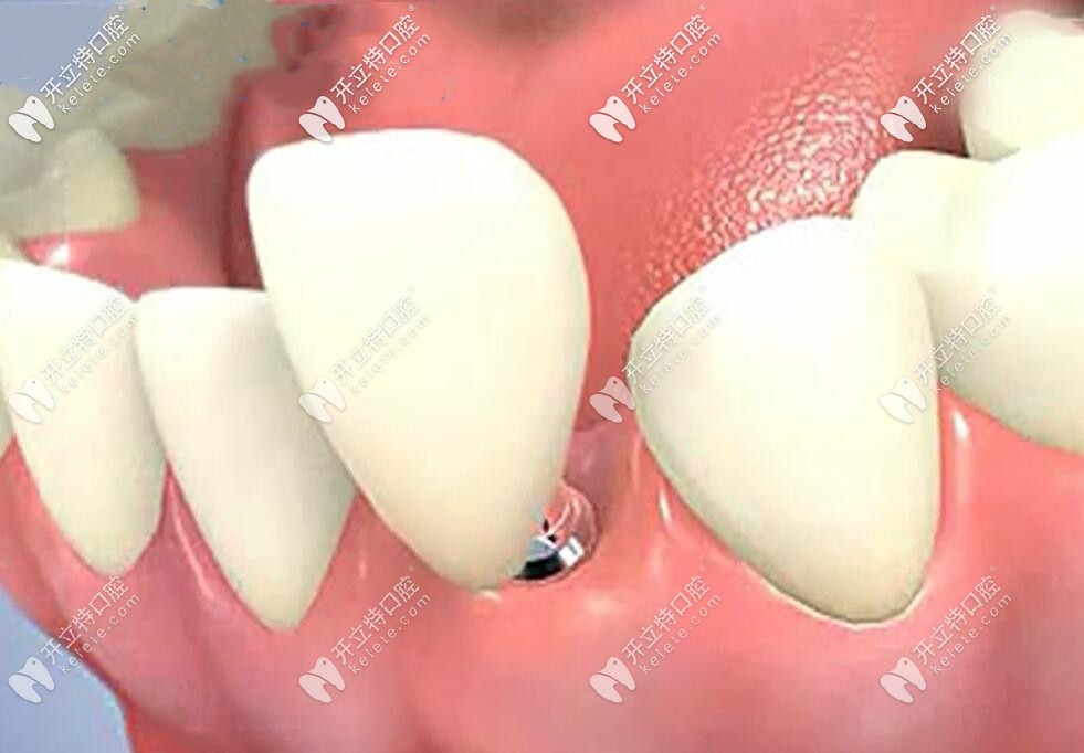 種植牙戴上牙冠和真牙一樣