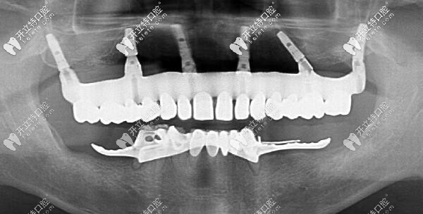 福州維樂ALL-ON-6上半口即刻種植牙后的CT片