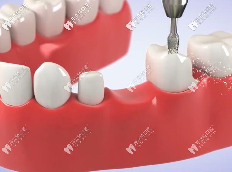 牙齒搭橋會損壞好牙