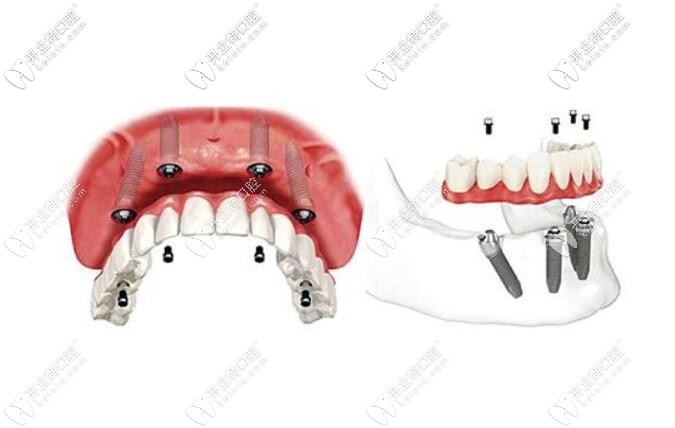 all-on-4/6全口種植牙