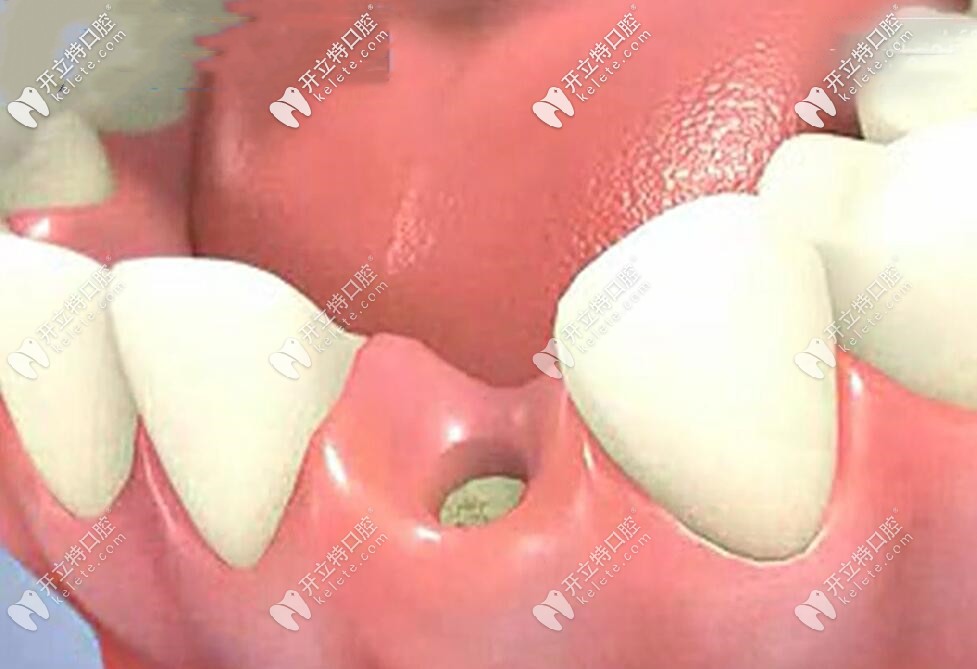 種植牙手術(shù)全過程演示