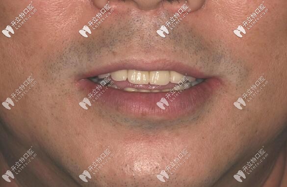 福州維樂口腔半口種植牙案例