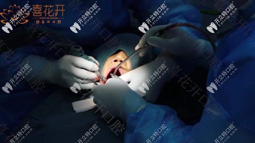 諾貝爾ALL-ON-6即刻負(fù)重種植牙馬上有牙,武漢人都來(lái)這種牙