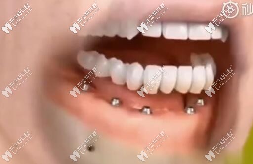 即刻負(fù)重種植牙 即刻負(fù)重種植牙