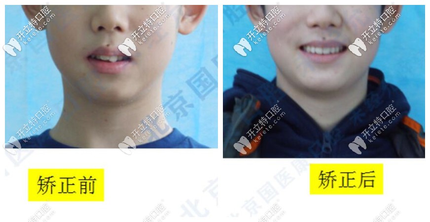 兒子深覆合+深覆蓋矯正前后臉型對比圖