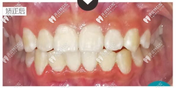 牙齒矯正后的樣子