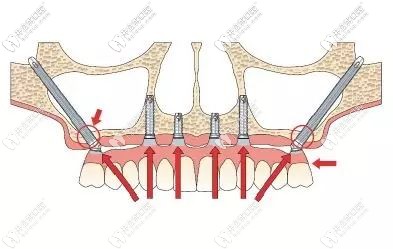 穿顴種植牙費(fèi)用