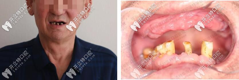 張大爺種牙前口腔情況