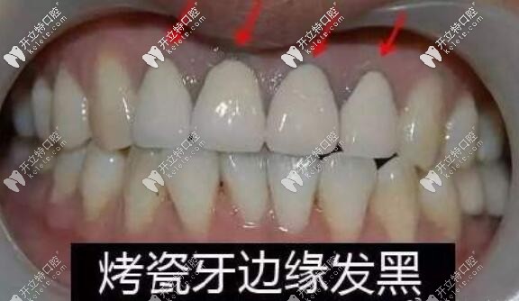 烤瓷牙牙齦發(fā)黑 烤瓷牙牙齦發(fā)黑