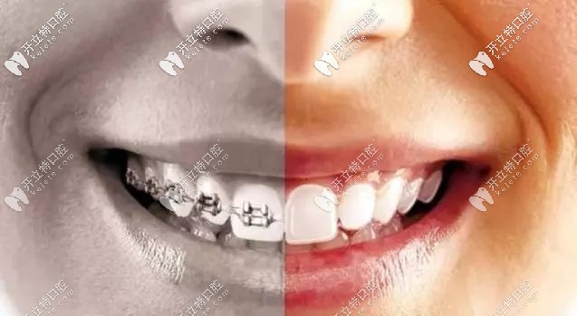 隱形牙套和鋼絲牙套對比圖
