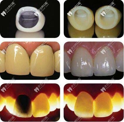 烤瓷牙和全瓷牙的圖片對(duì)比區(qū)別 烤瓷牙和全瓷牙的圖片對(duì)比區(qū)別