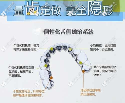 舌側(cè)矯正技術(shù)