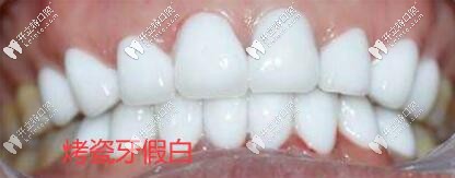 烤瓷牙假白圖片 烤瓷牙假白圖片