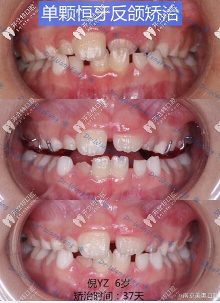 孩子恒牙反頜ETA早期矯治37天效果驚人,雖然價(jià)格比mrc貴