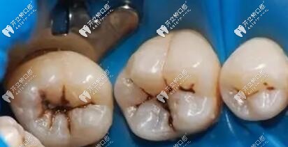 口腔治療中的橡皮障技術(shù)