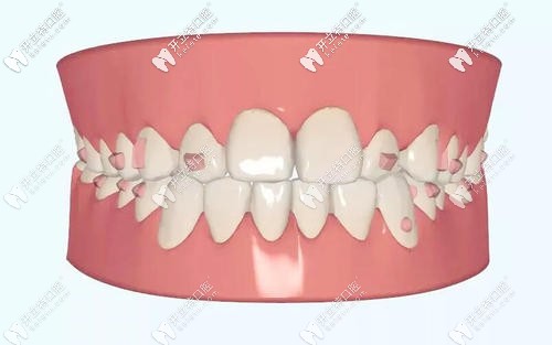 牙齒矯正的設(shè)計(jì)方案