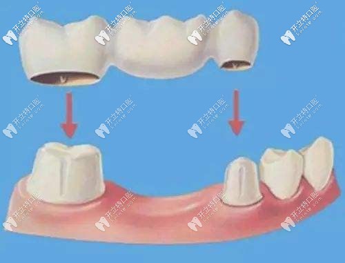 烤瓷橋修復(fù)示意圖