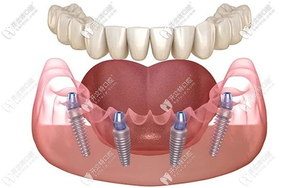 All-on-4種植修復(fù)技術(shù)