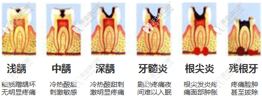 齲齒的不同等級