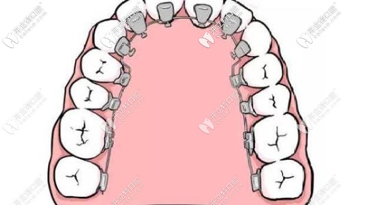舌側(cè)矯正對(duì)醫(yī)生要求更多