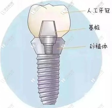 初期穩(wěn)定性對種植體的壽命有影響