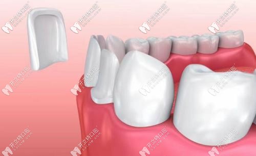 牙齒貼面修復(fù)