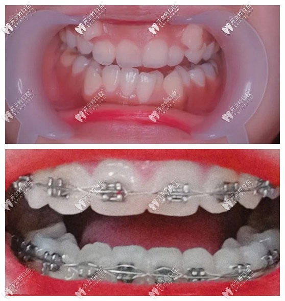 虎牙外凸很難矯正?聽說她戴damon自鎖牙套5個(gè)月虎牙被拉正了