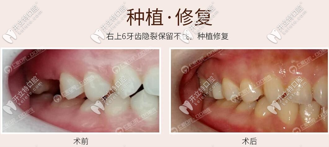 牙齒隱裂害我花了1萬(wàn)多做了法國(guó)安卓健種植牙,30+就有假牙了