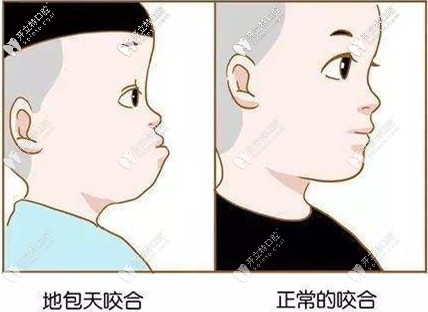 兒童地包天和正常的咬合對比