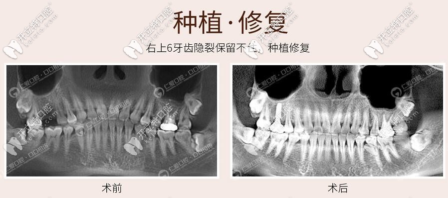 <!--<i data=20240703-sp></i>-->醫(yī)院口腔科法國安卓健種植牙案例 <!--<i data=20240703-sp></i>-->醫(yī)院口腔科法國安卓健種植牙案例