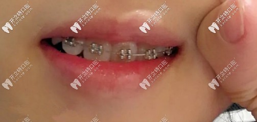 矯正虎牙多久能拉下來？我用了不到半年哦